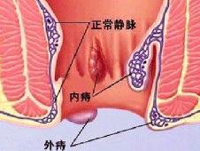 塗抹痔瘡膏注意事項