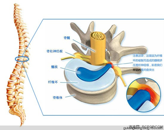 微創治療腰椎間盤突出