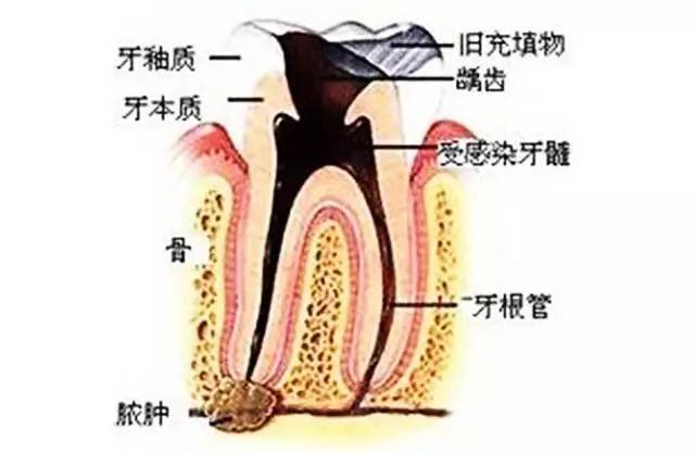 牙髓息肉