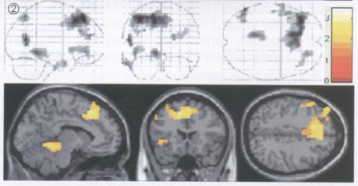 圖 2 為正常成人的腦激活圖