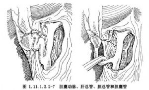 逆行膽囊切除術