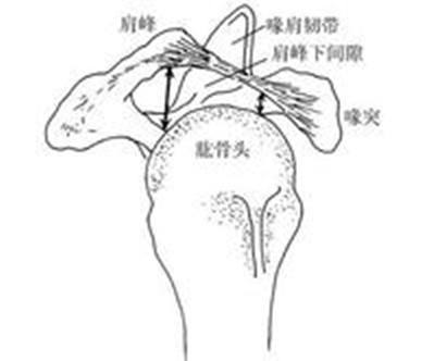 肩部撞擊症圖解