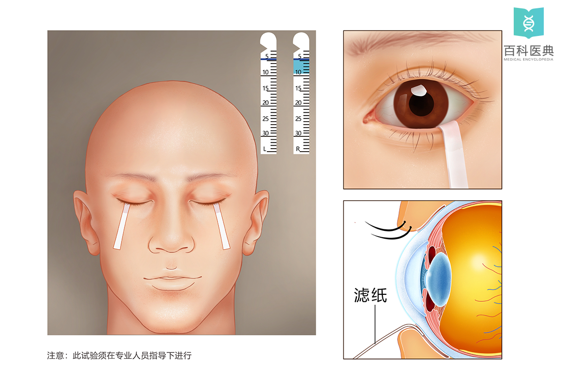 乾眼症(角結膜乾燥症)