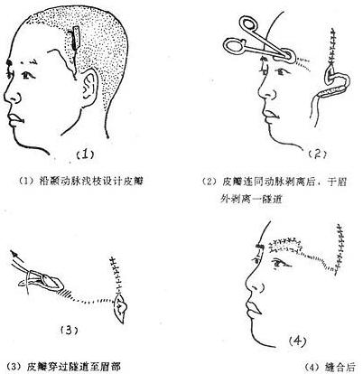 眉再造