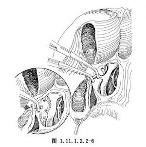 逆行膽囊切除術