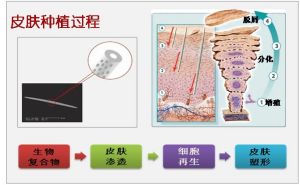 液態微針