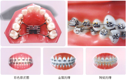 固定矯治器