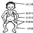 肋骨及胸骨下吸入性凹陷