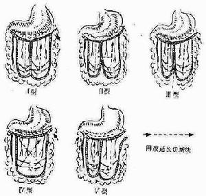 血栓性脈管炎