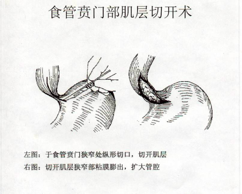 賁門肌層切開術