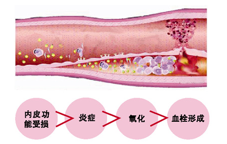 動脈血栓