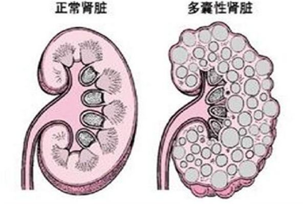 多囊腎的囊腫去頂減壓術