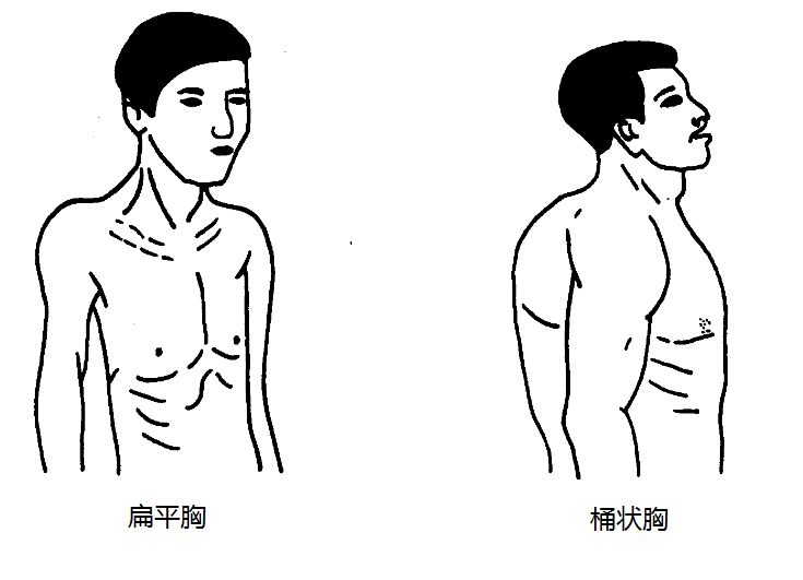 扁平胸、桶狀胸