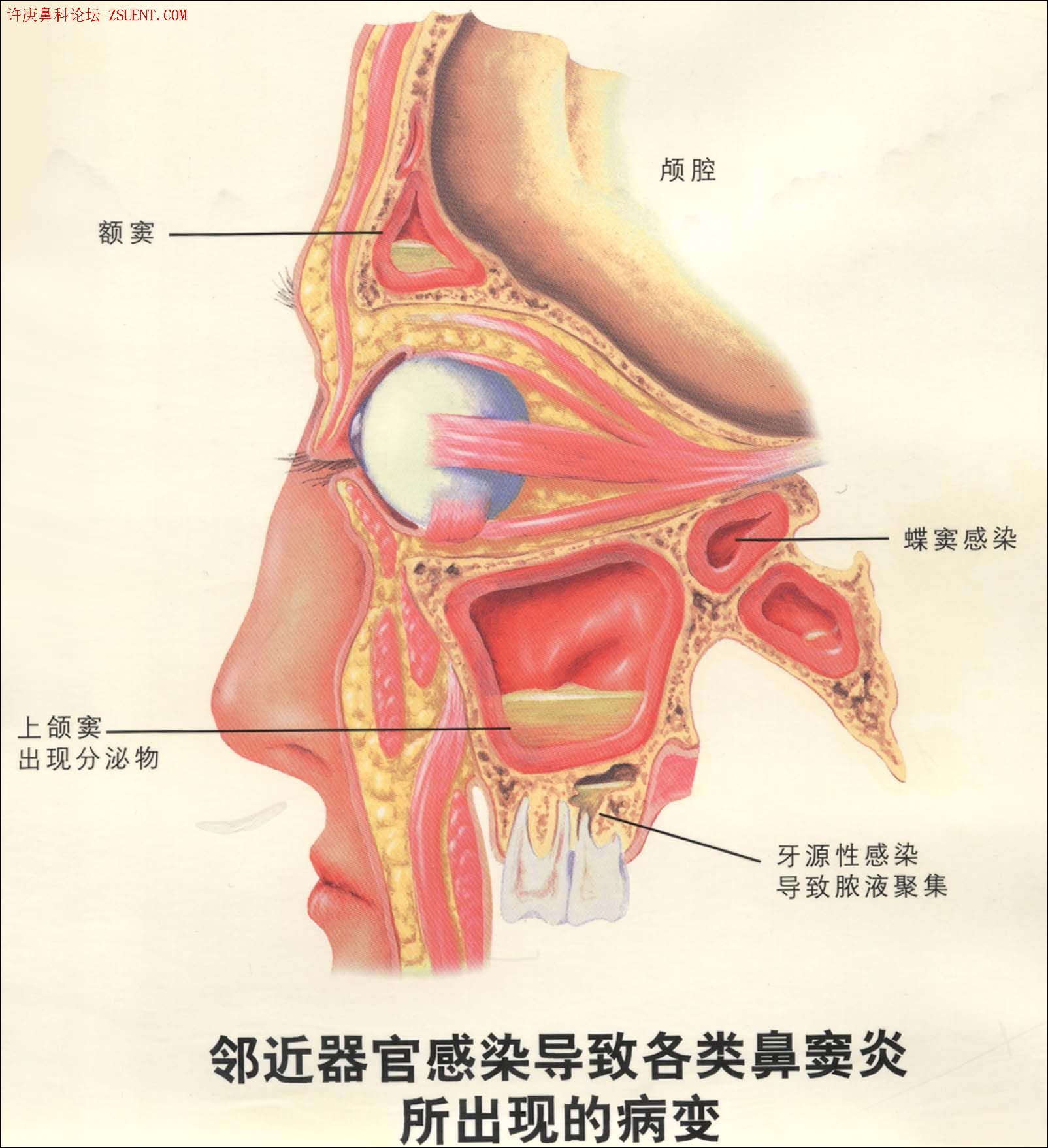 蝶竇炎