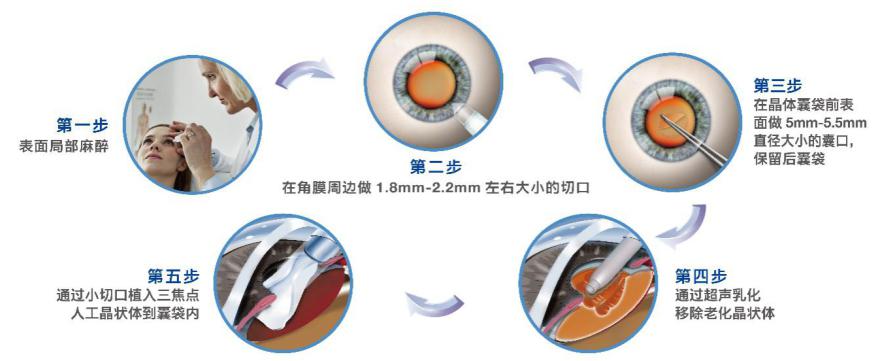 三焦點人工晶體