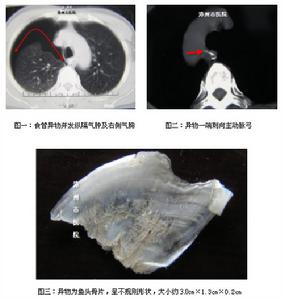 雙食管畸形