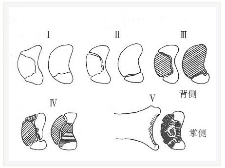 月狀骨無菌壞死