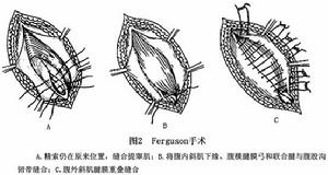 成人腹股溝斜疝(二)