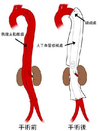 梅毒性主動脈瘤