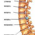腰椎間盤鈣化