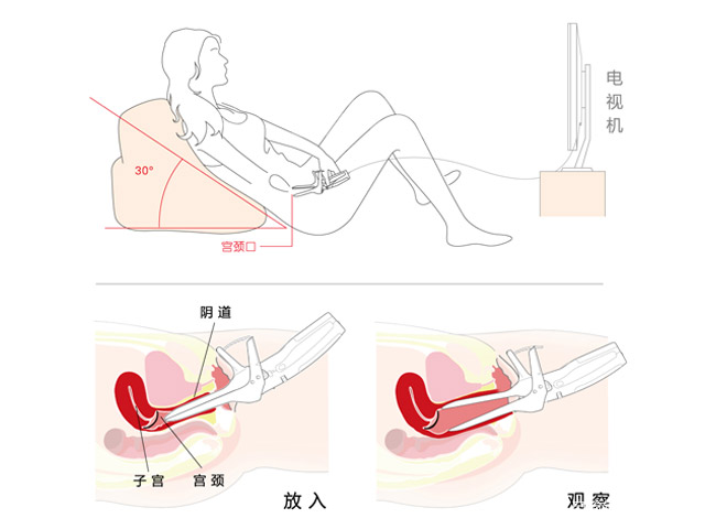 婦科自檢鏡