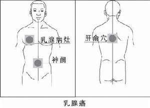 乳腺癌症狀