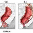 肛腸脫垂