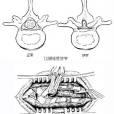 腰椎管、根管擴大減壓術