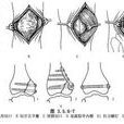 股骨髁部骨折內固定術