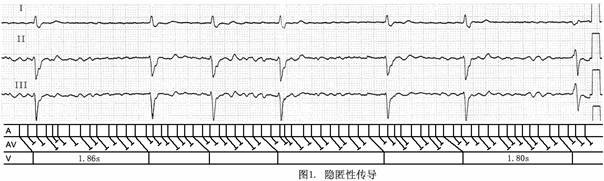 圖1房顫伴隱匿性傳導