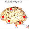 腦神經膠質瘤