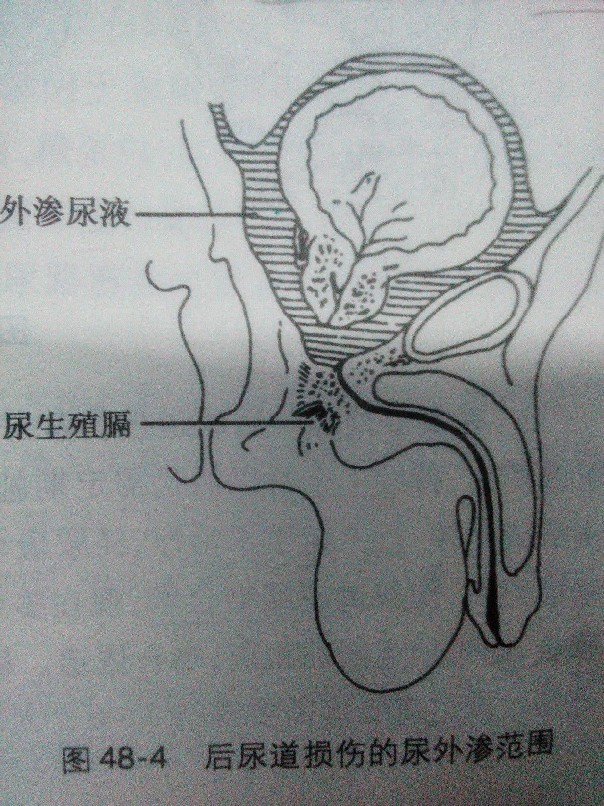 後尿道斷裂