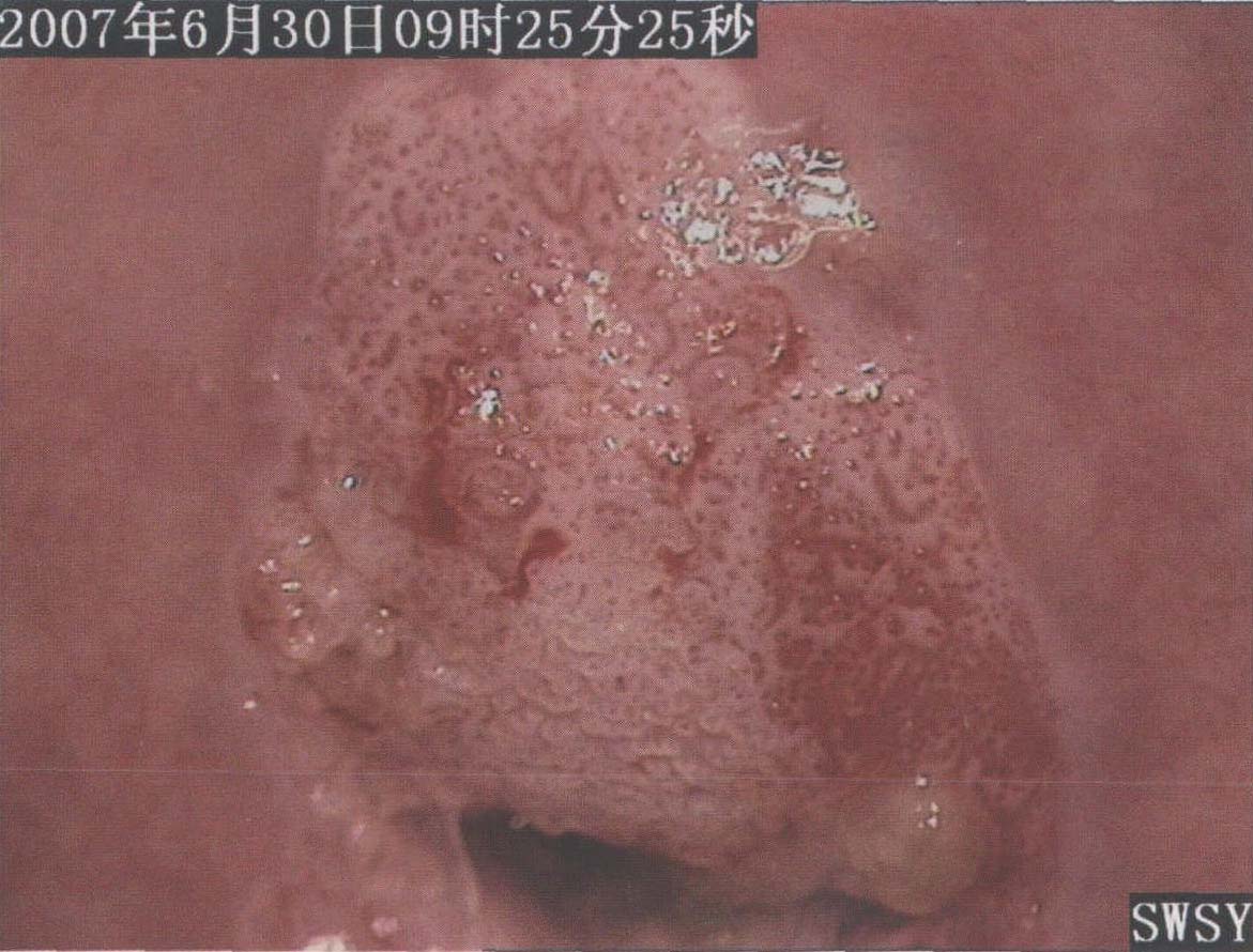 子宮頸白斑