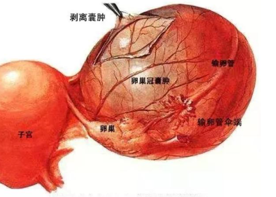 卵巢多發性囊腫