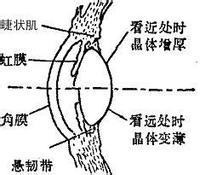 近視眼恢復