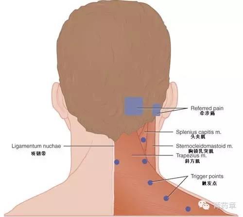 胸背肌筋膜炎