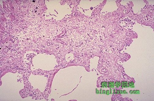 特發性瀰漫性肺纖維化