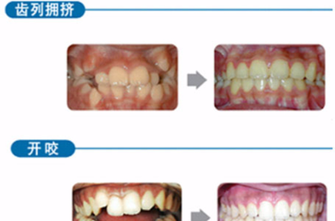 牙齒矯形