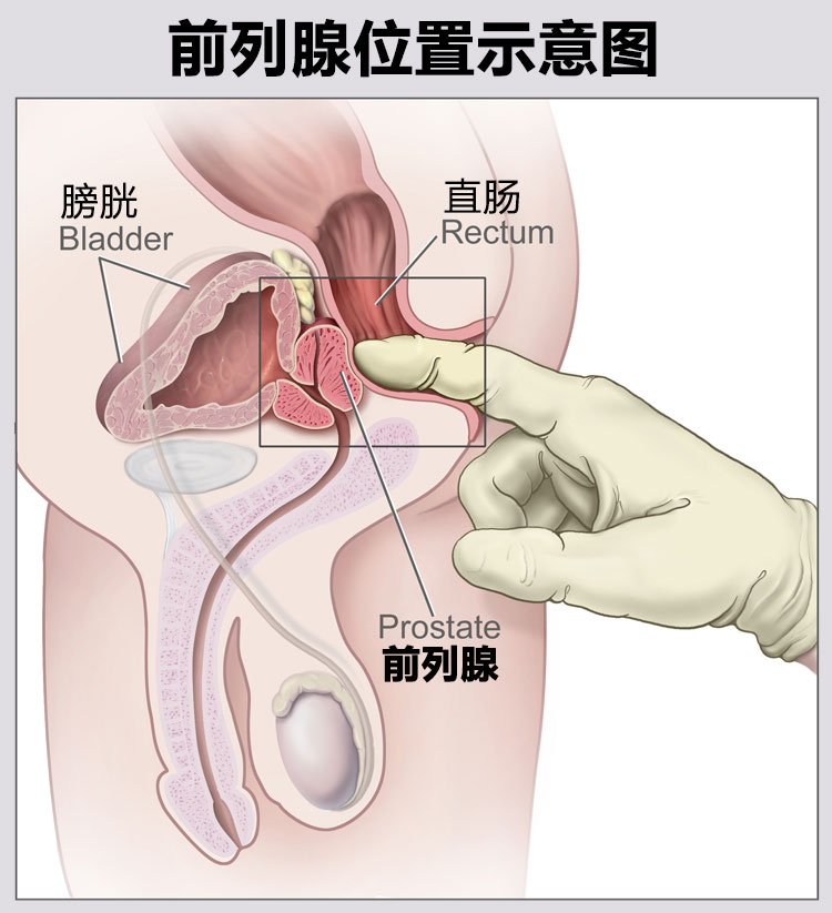 痔-前列腺肥大-陽痿綜合徵