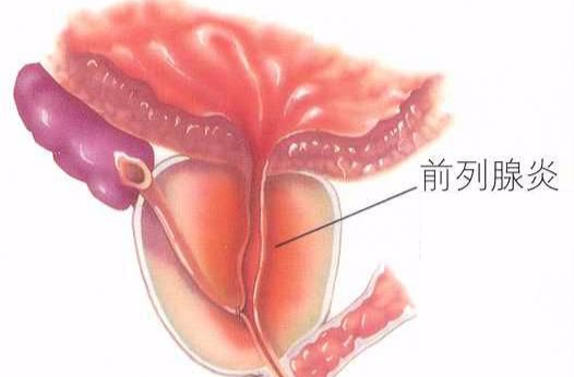 真菌性前列腺炎