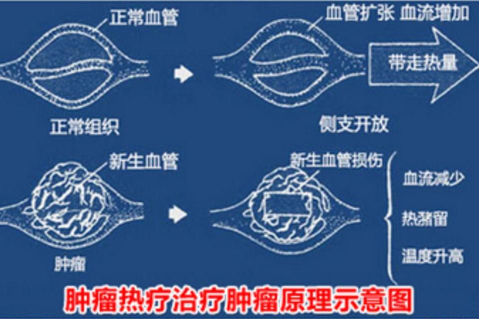 腫瘤熱療