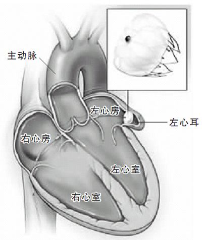 左心耳封堵術