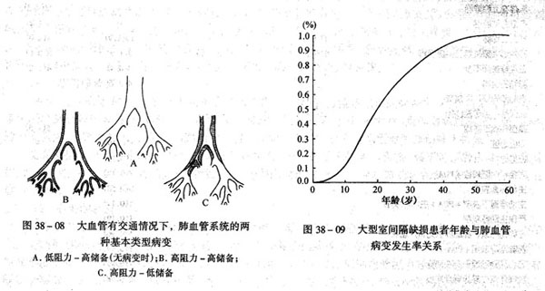 矯正型大動脈錯位