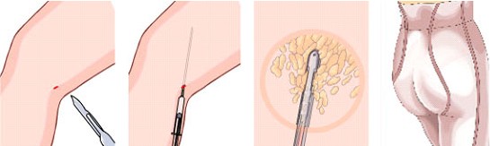 大腿吸脂