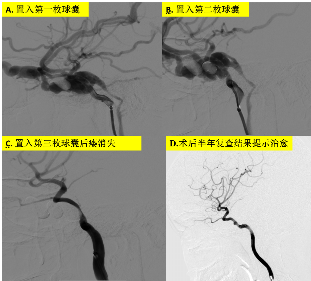 頸內動脈海綿竇瘺