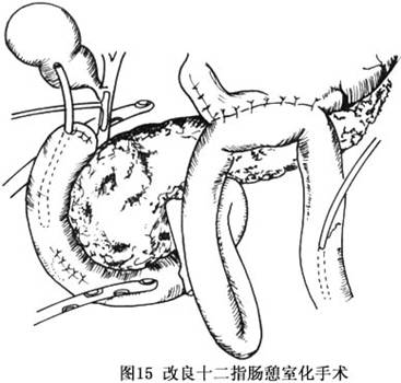 胰腺破裂