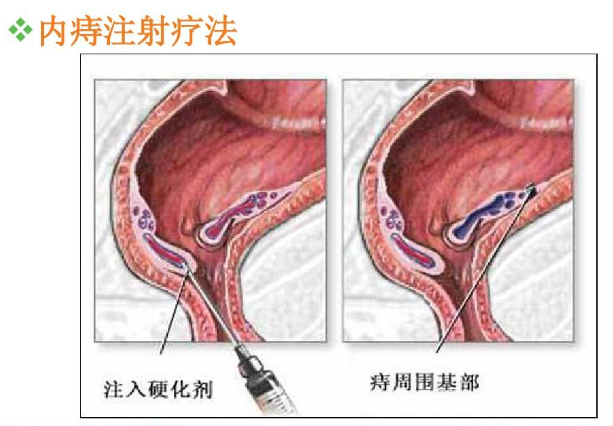 內痔注射療法