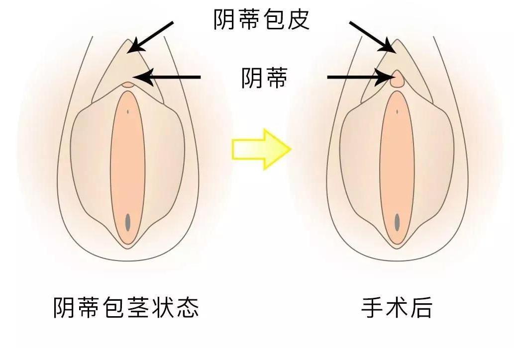 陰蒂粘連整形