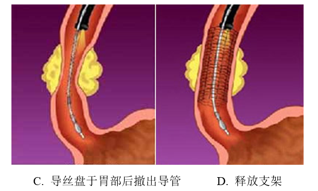 食道支架