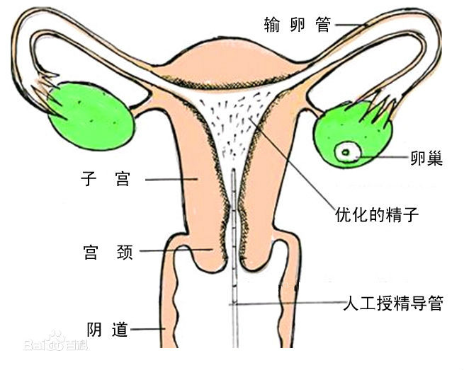 體外人工受精